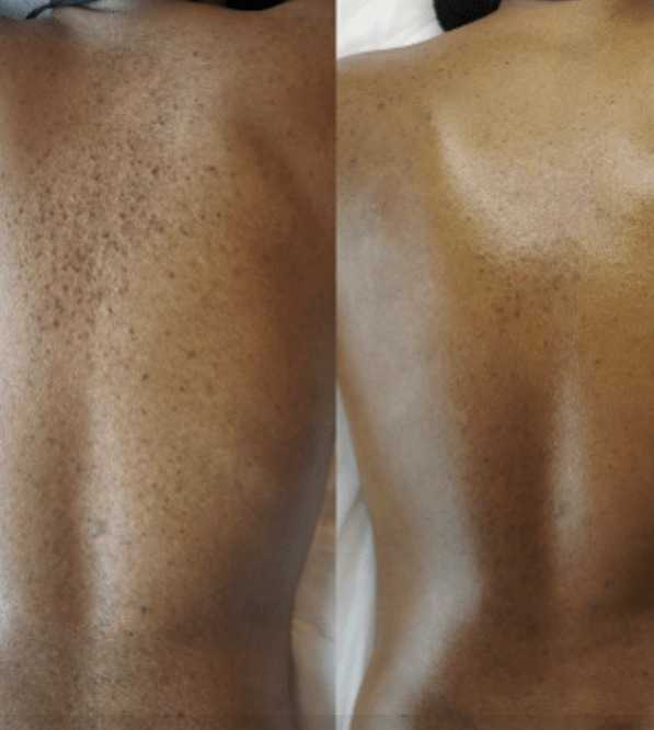 ALEX COSMETIC + HERBS2PEEL – Beauty&nbsp; Peel (B-Peel) & Corrective Peel (C Peel)