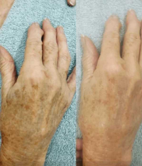 ALEX COSMETIC + HERBS2PEEL – Beauty&nbsp; Peel (B-Peel) & Corrective Peel (C Peel)