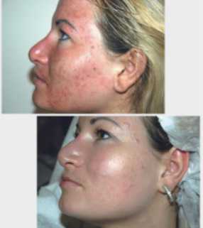 IN-PERSON-TRAINING-ALEX-COSMETIC-HERBS2PEEL-–-Beauty-Peel-B-Peel-Corrective-Peel-C-Peel