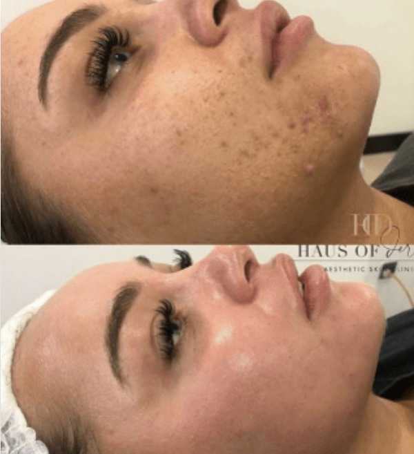 Training-ALEX-COSMETIC-HERBS2PEEL-–-Beauty-Peel-B-Peel-Corrective-Peel-C-Peel